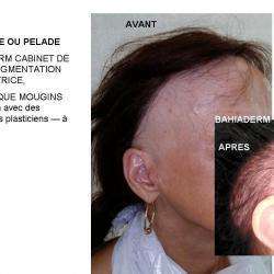 Manucure Bahia Derm - 1 - Dermopigmentation Capillaire Suite à Une Alopécie - 