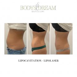 Bodys Dream - Drainage Renata França - Lipocavitation - Hydrafacial - Maderothérapie Bordeaux