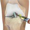 Injections De P.r.p. (plasma Riche En Plaquettes) Pour Soulager Les Douleurs De L'arthrose, Lésion D’un Tendon, Lésion Musculaire ….